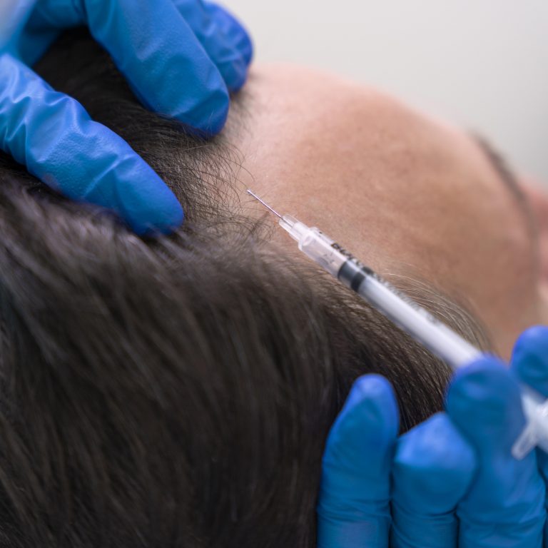 man-getting-hair-loss-treatment